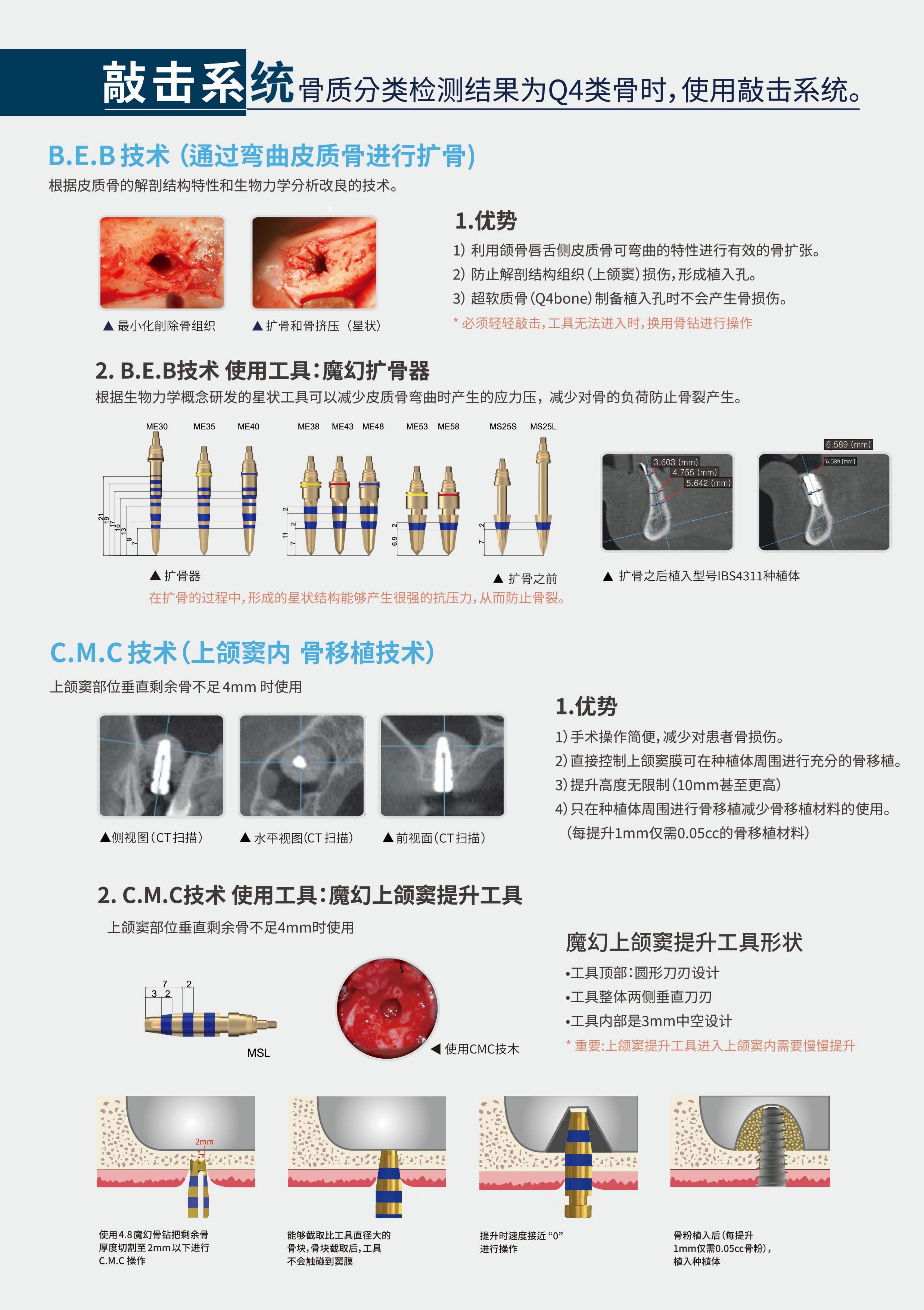 种植牙黑科技！IBS-FC种植体，重新定义缺牙修复