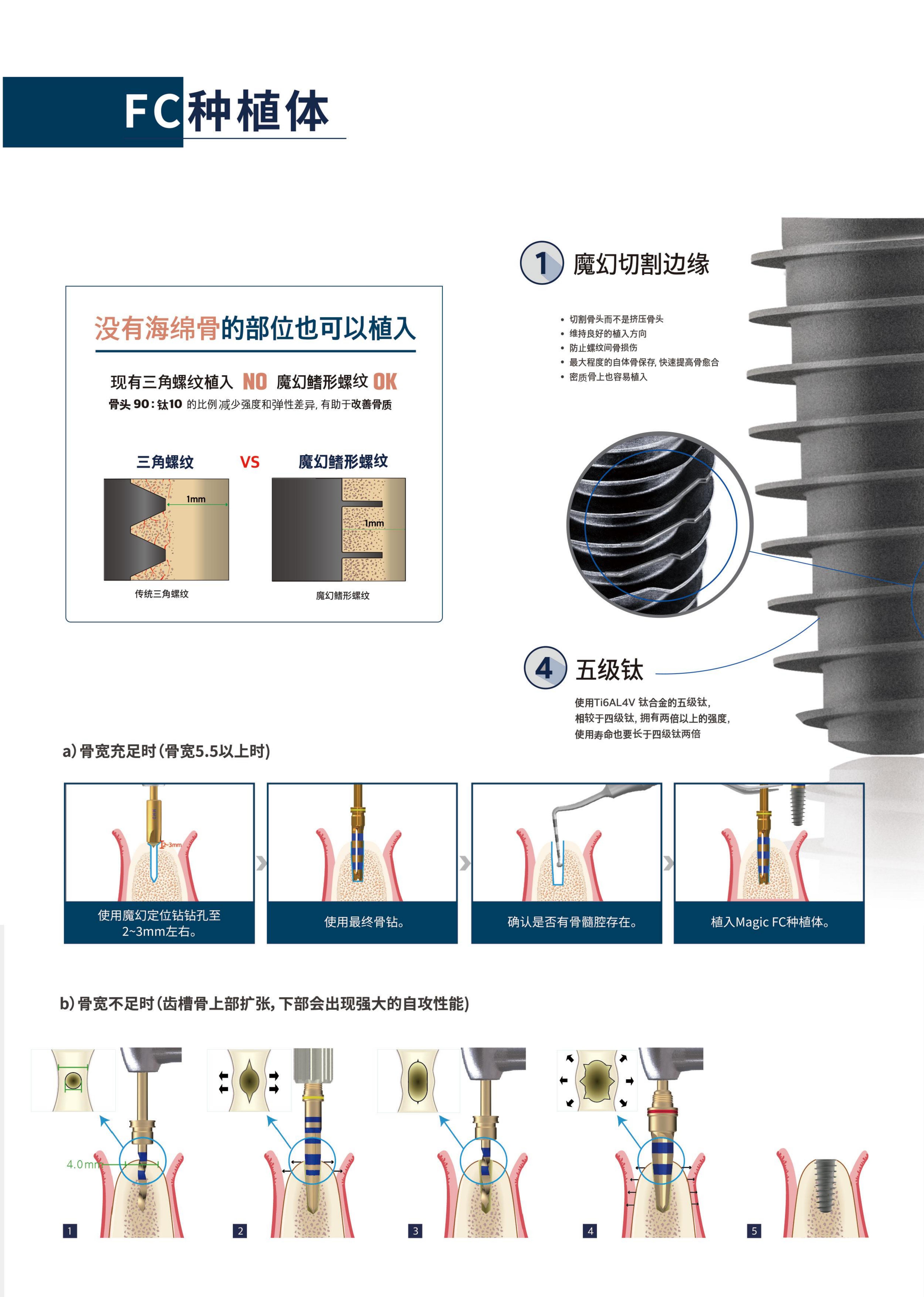 种植牙黑科技！IBS-FC种植体，重新定义缺牙修复