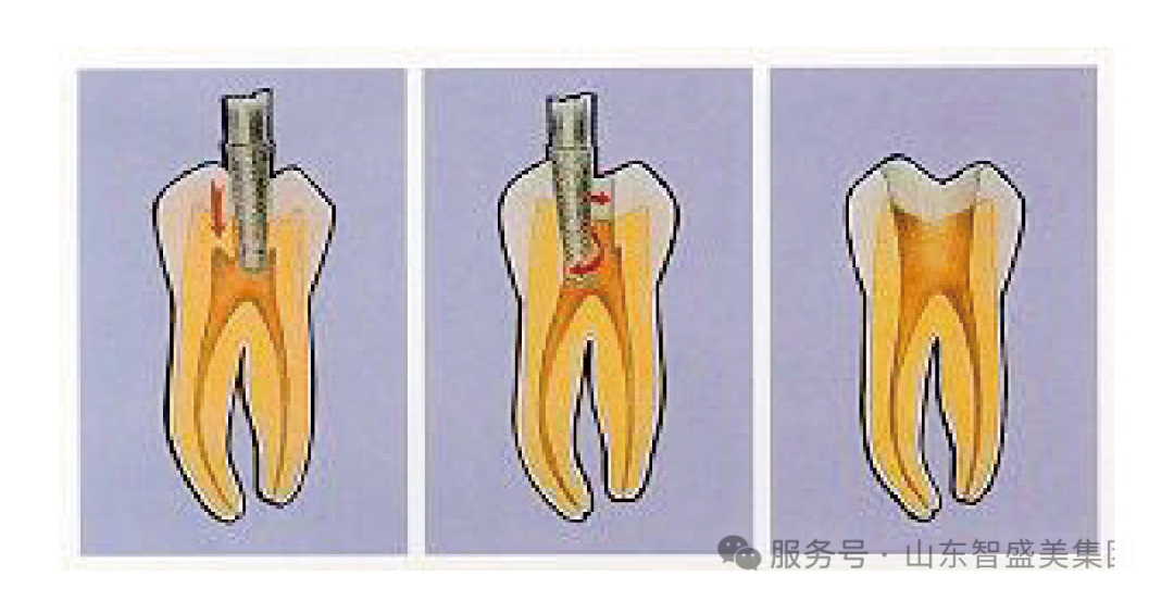 告别根管治疗&ldquo;盲操作&rdquo;！智盛美根管锉系统让复杂根管无所遁形