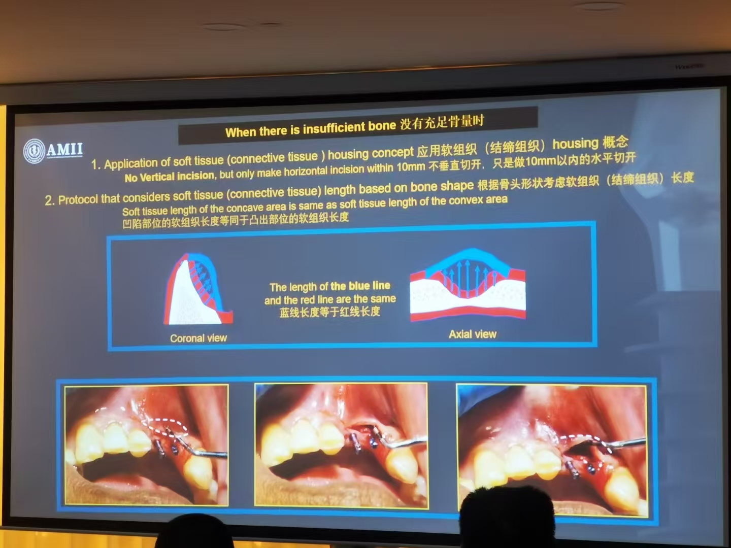 微创种植新时代：IBS系统如何实现&ldquo;以骨生骨&rdquo;，挑战极低骨量种植